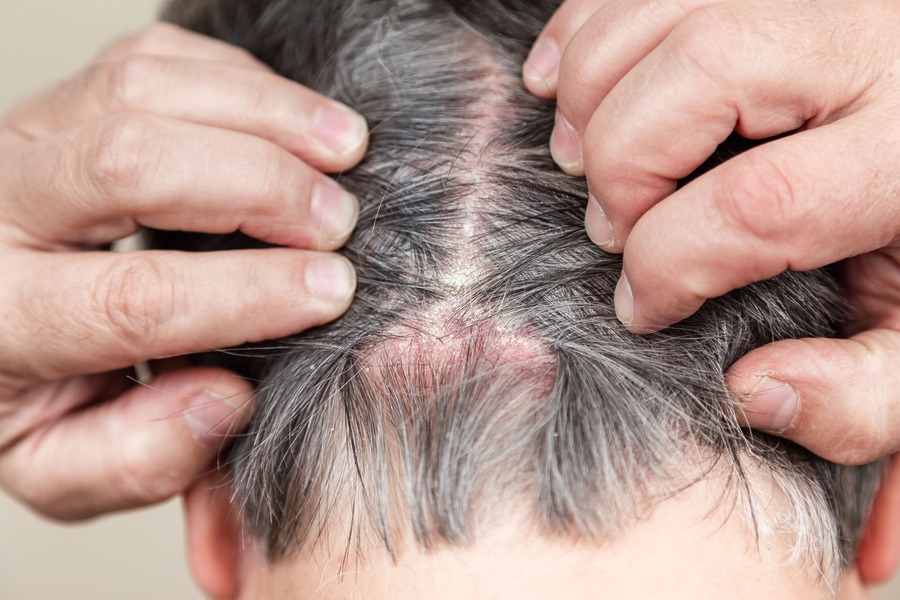 Scalp Psoriasis