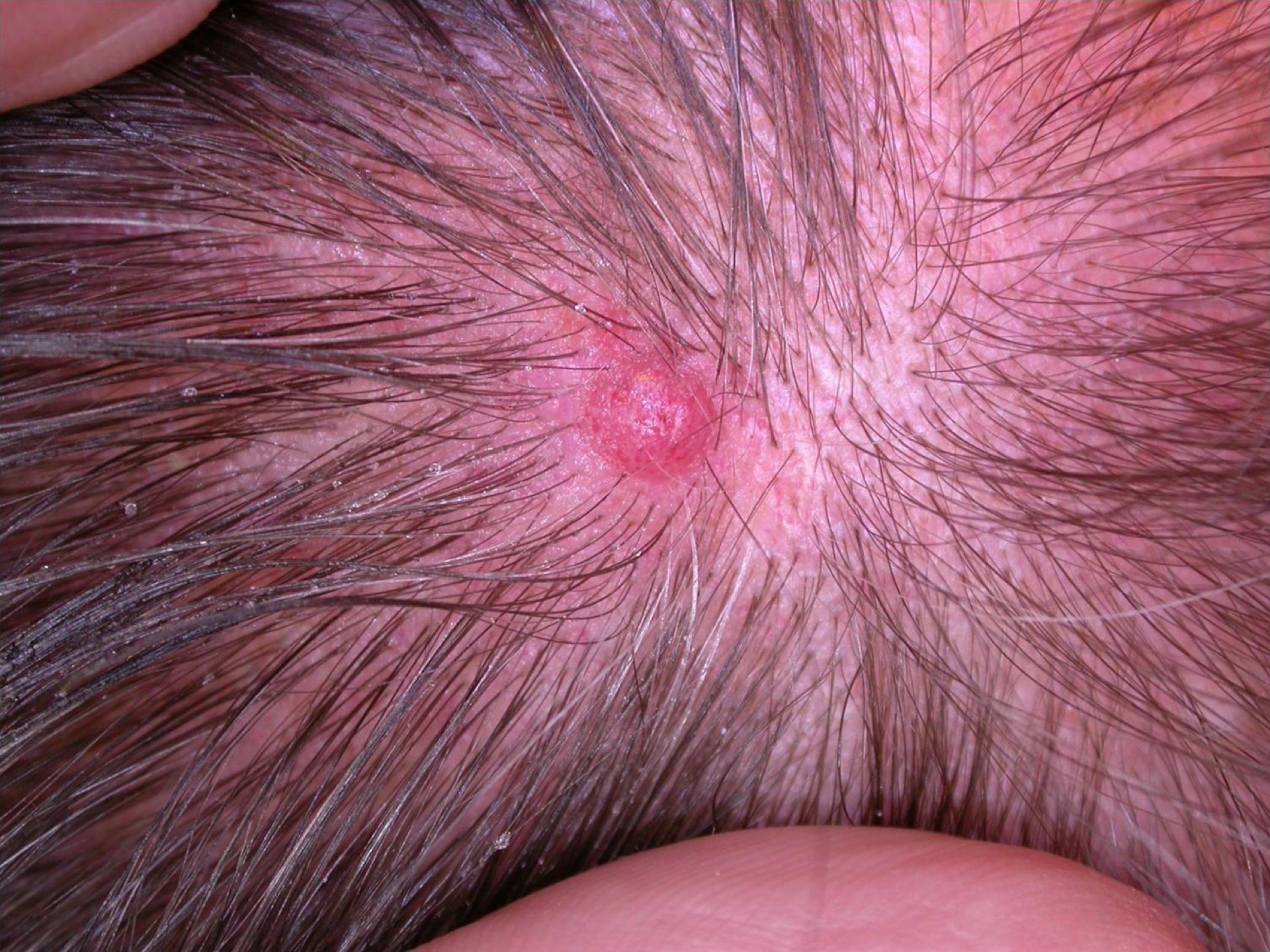 Scalp melanoma