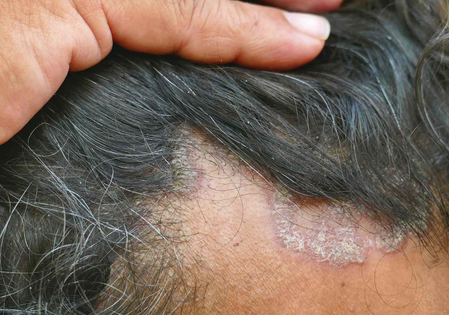 Scalp psoriasis