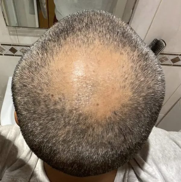 3000 graft hair transplant before