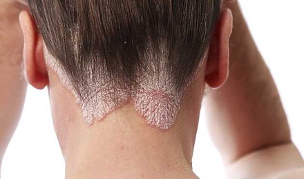 Hair Loss Seborrheic Dermatitis Featured Image