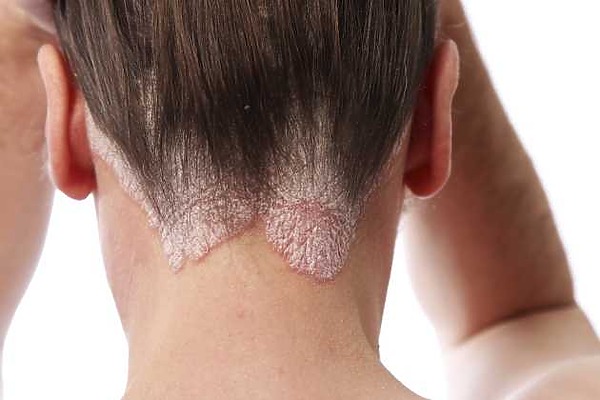 hair loss seborrheic dermatitis featured image