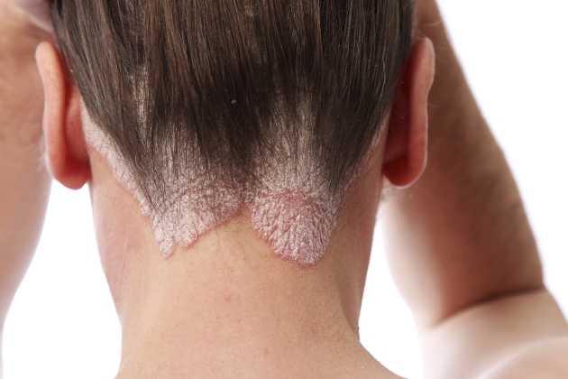 Hair Loss Seborrheic Dermatitis Featured Image