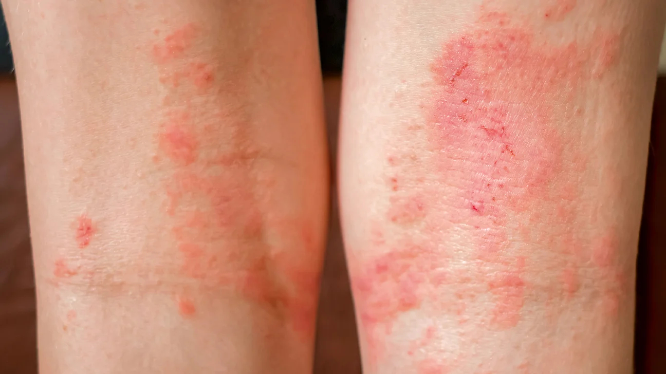 Seborrheic dermatitis on the lower limbs