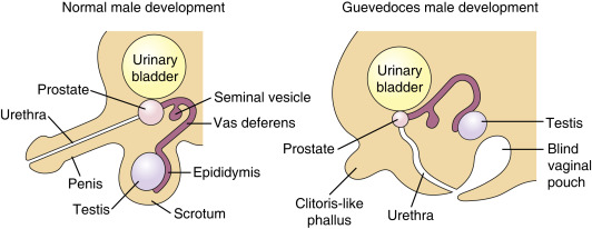 Sexual differentiation and development in a normal male at birth and a male with 5α-reductase deficiency