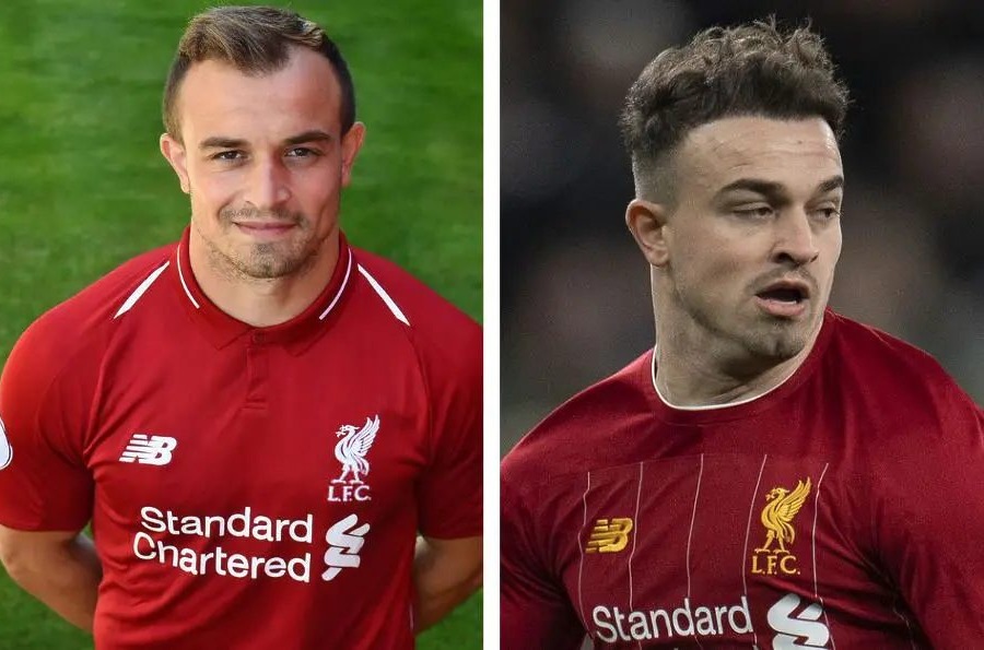 Xherdan Shaqiri Hair Transplant: Everything You Need To Know