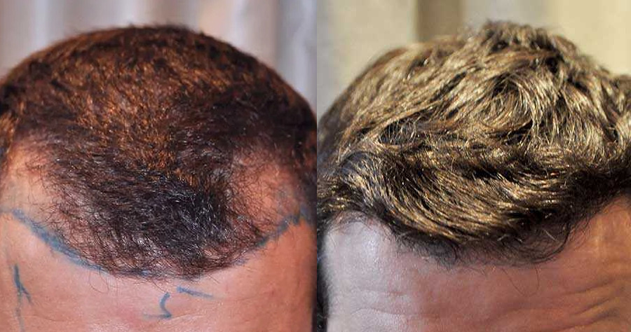 Temple Hair Transplant Featured Image