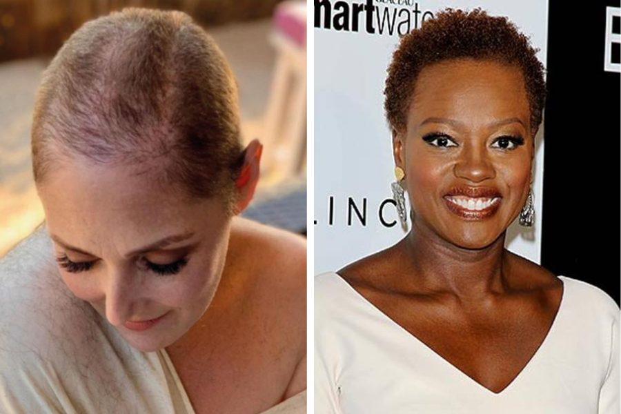 Celebrity Female Hair Loss Featured Image