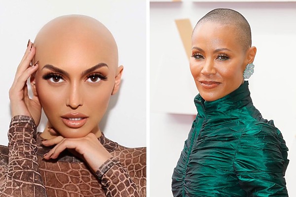 celebrities with alopecia featured image