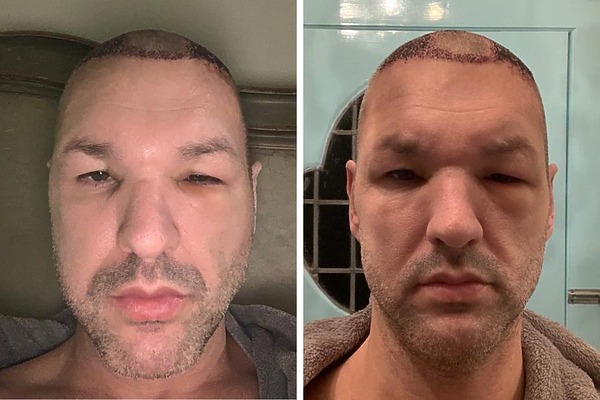 hair transplant swelling featured image