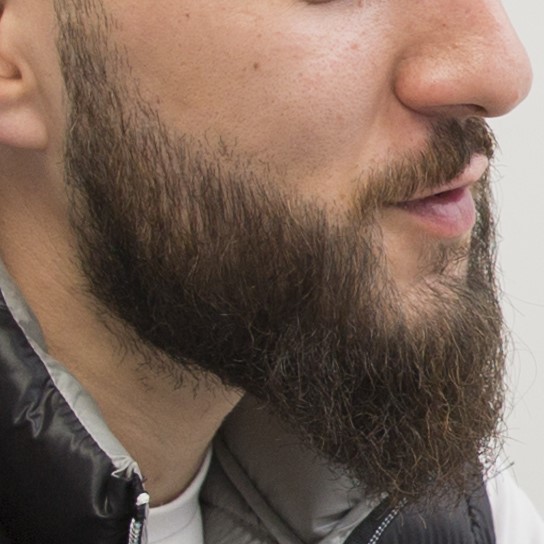 Beard Transplant, Wimpole Clinic