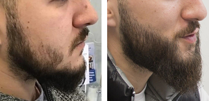 man before and after his beard transplant