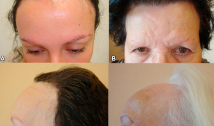 Women With Diagnosed Frontal Fibrosing Alopecia At Different Stages; Premenopausal 30-year-old Woman (a), Postmenopausal 63-77-year-old Women With Frontotemporal Recession And Eyebrow Loss (b-d)