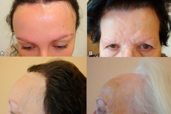 Women With Diagnosed Frontal Fibrosing Alopecia At Different Stages; Premenopausal 30-year-old Woman (a), Postmenopausal 63-77-year-old Women With Frontotemporal Recession And Eyebrow Loss (b-d)