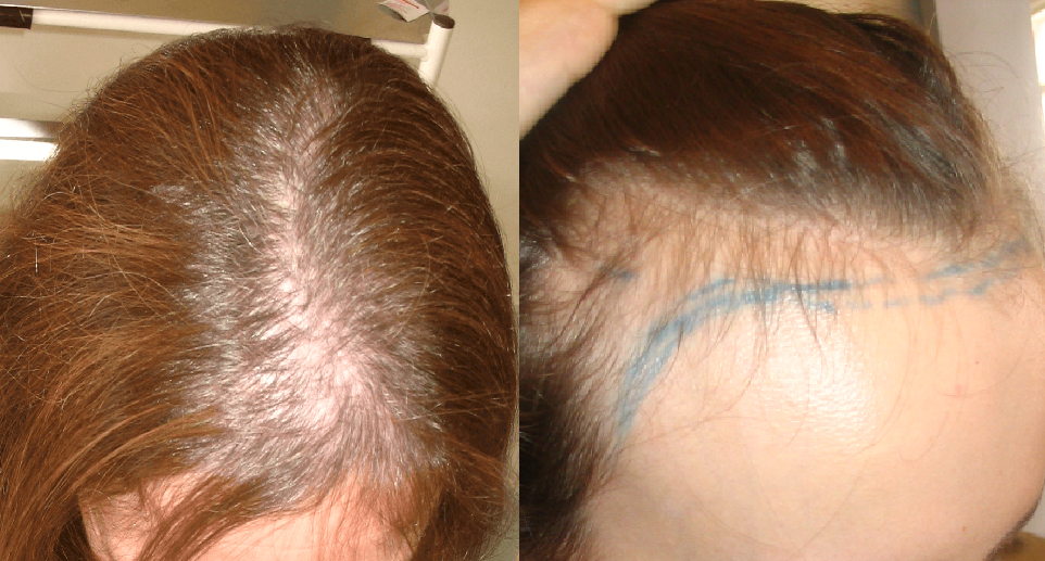 androgenetic alopecia in female patient