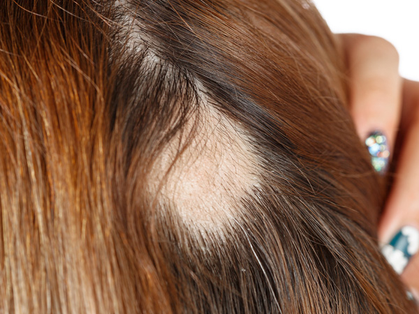 bald spot due to alopecia areata