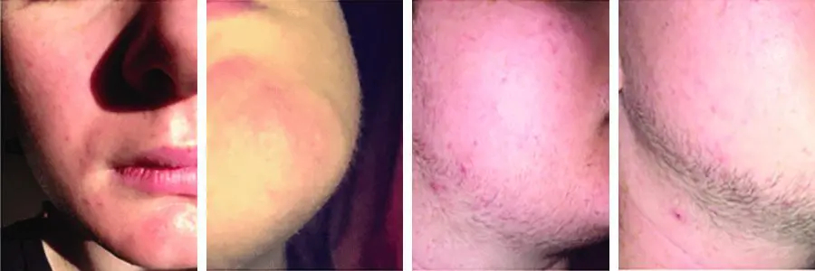 before and after beard growth examples