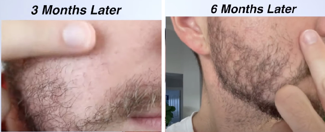 Derma roller for beard results