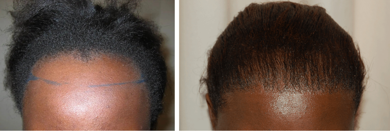 before and 12 months after FUT hair transplant results in a female patient