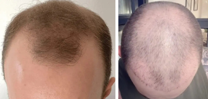 Before and 2 months after crown hair transplant on an m-shaped hairline