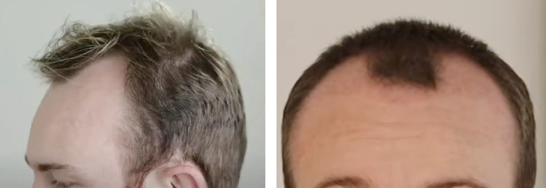 before and 2 months after hair transplant on an m-shaped hairline