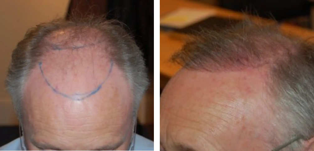 before and 3 months after 2300 graft hair transplant