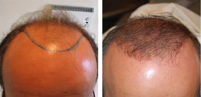 before and 3 months after crown transplant using the FUE hair transplant technique