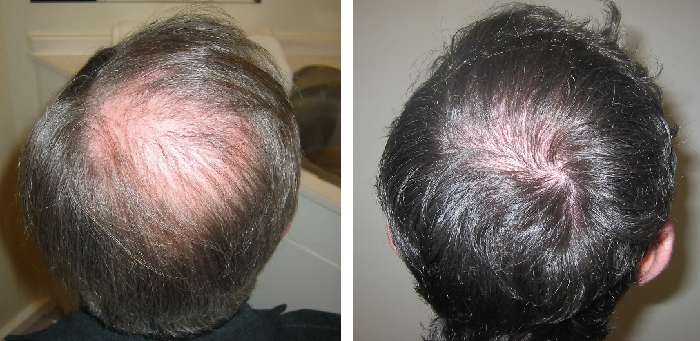 before and 5 months after crown hair transplant