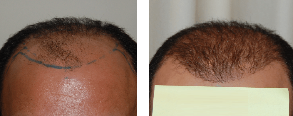 before and 8 months after FUE hair transplant surgery