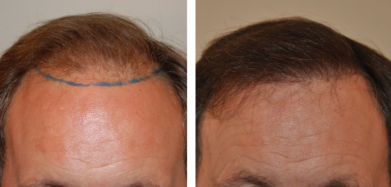 before and after 1000 grafts FUE hair transplant