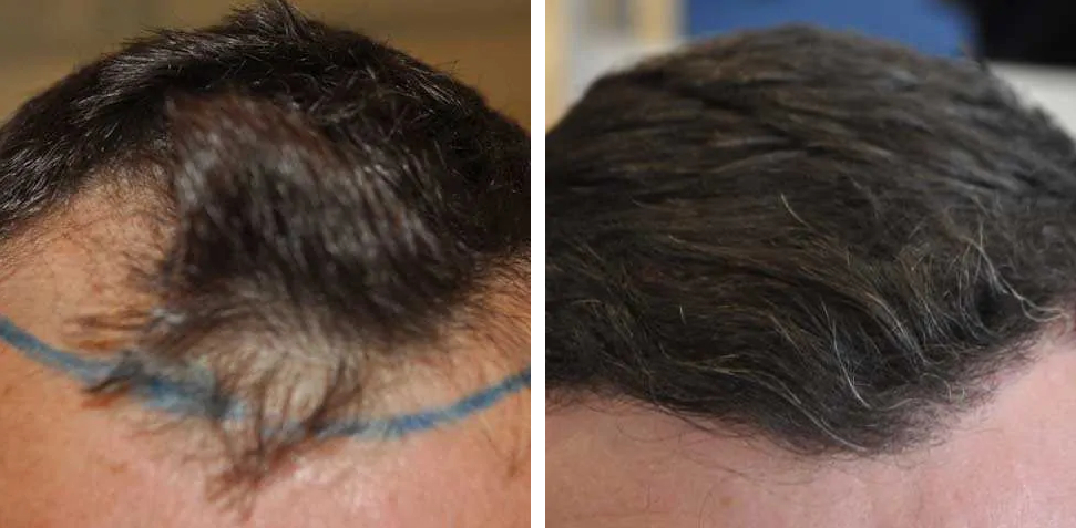 before and after 1500 graft hair transplant