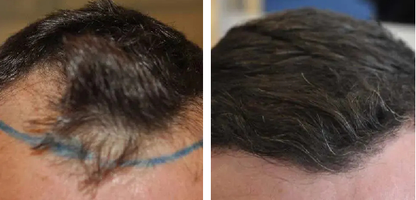 before and after 1500 graft hair transplantation