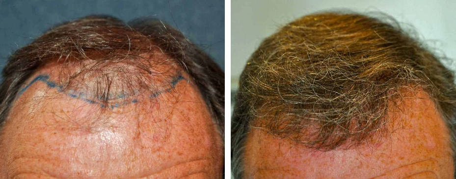 before and after 1600 FUE hair transplant