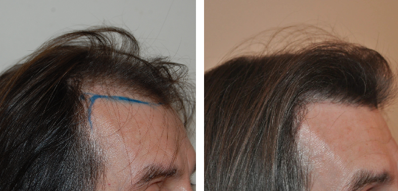 before and after 1800 FUE hair transplant