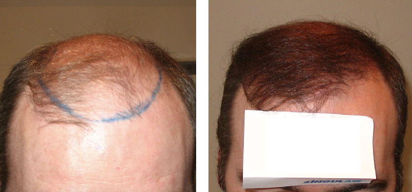 before and after 2200 graft FUE hair transplant