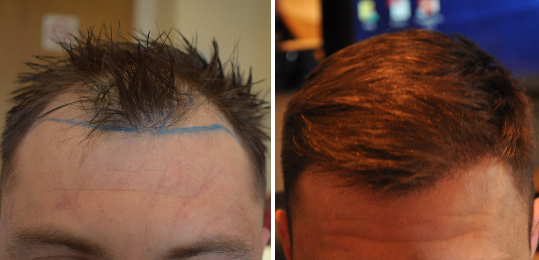 before and after 2400 FUE hair transplant