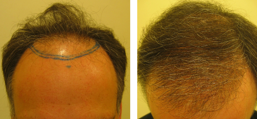 before and after 2500 graft hair transplant