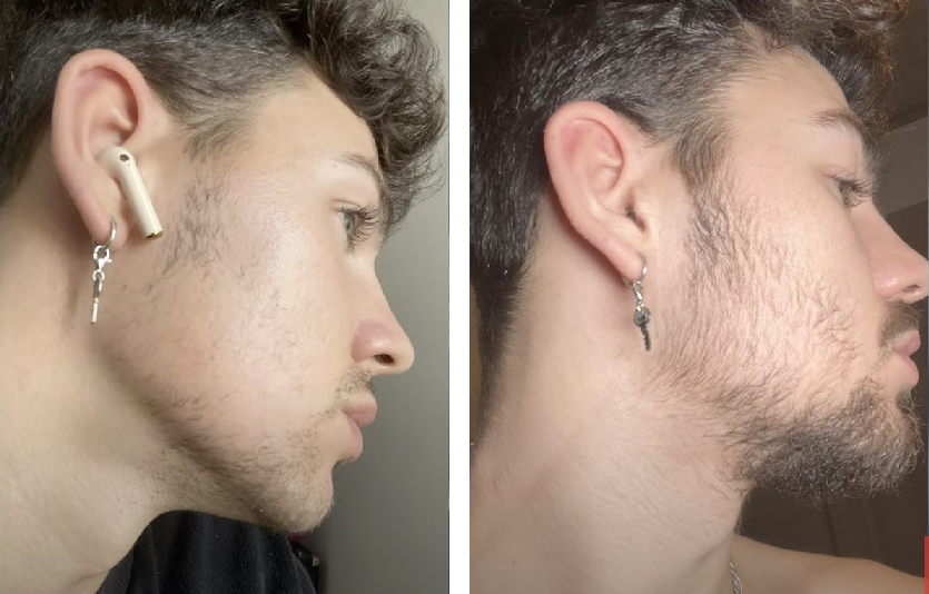 Beard rolling and minoxidil before and after