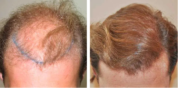 before and after 3000 graft hair transplant