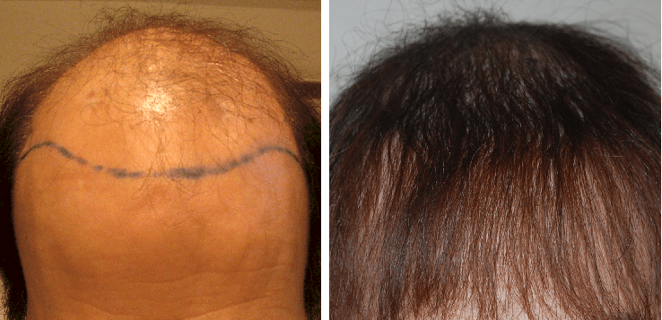 before and after 4500 graft hair transplant