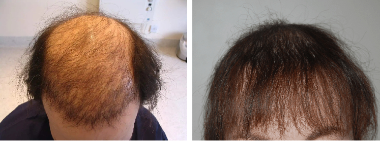 before and after 5000 grafts transplant