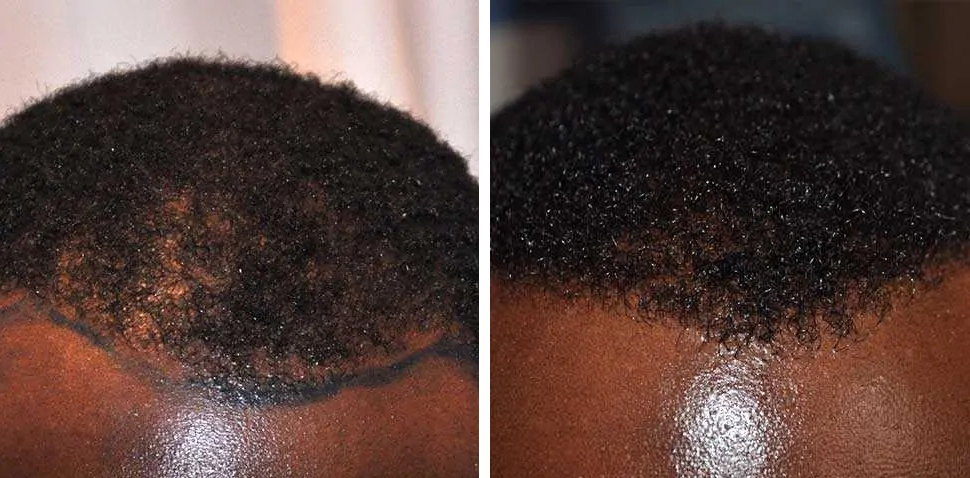 before and after afro hair transplant