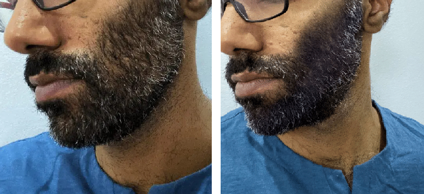 Man before and after using beard thickening spray