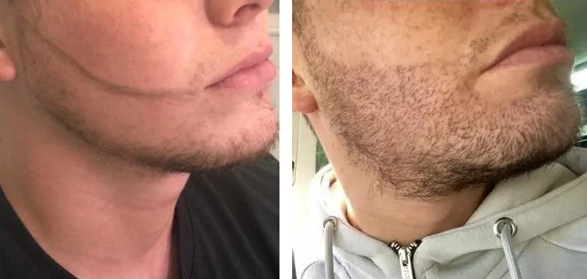 before and after beard hair transplant