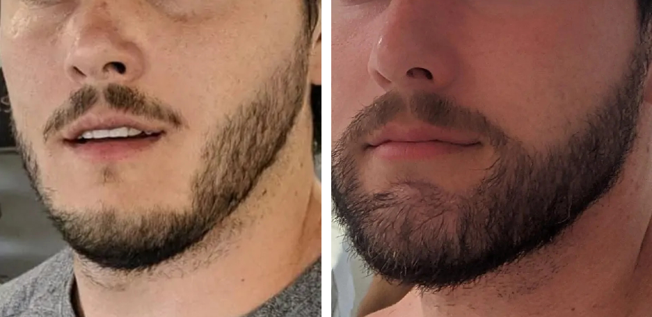 male patient before and after a beard transplant