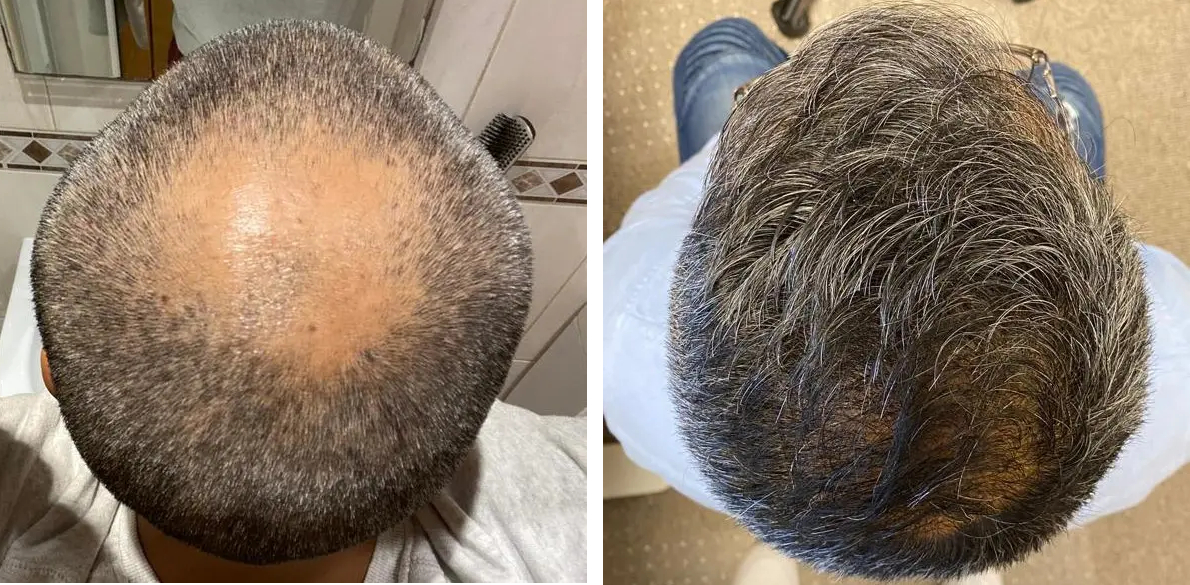 before and hair growth results of permanently transplanted hair on the crown after 15 months