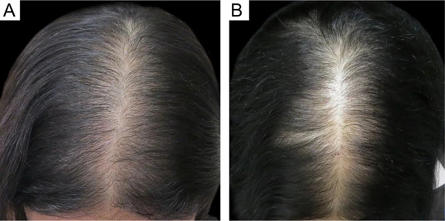 before and after derma rolling