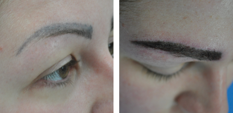 before and after eyebrow transplant