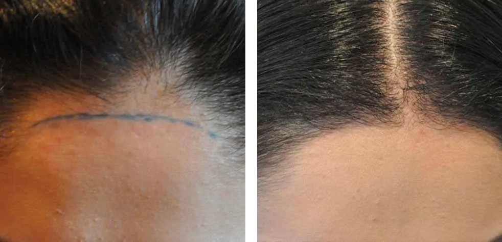 before and after female hair transplant