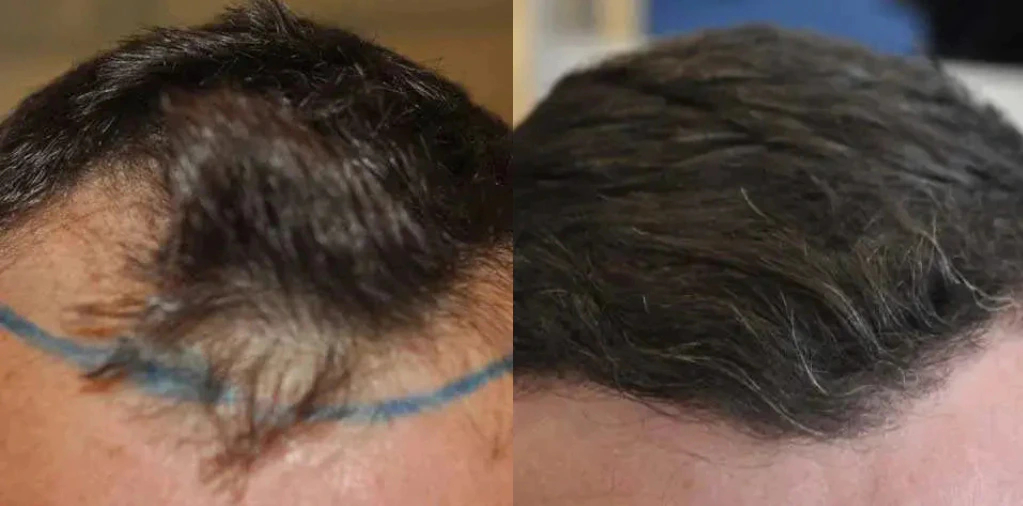 before and after hair transplant